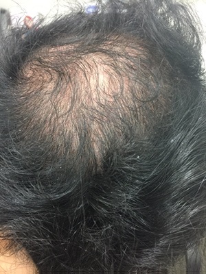 What is Tinea Capitis TRICHOLOGY CENTRE  Toronto