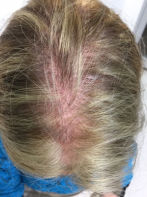 29yo female scalp -April 2015