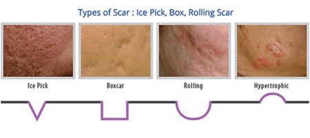 Types of Acne Scars